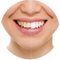 Veneer Treatments